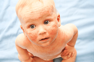 baby eczema