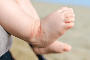 baby eczema