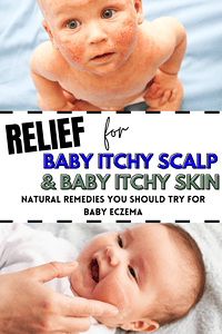 baby eczema natural remedies